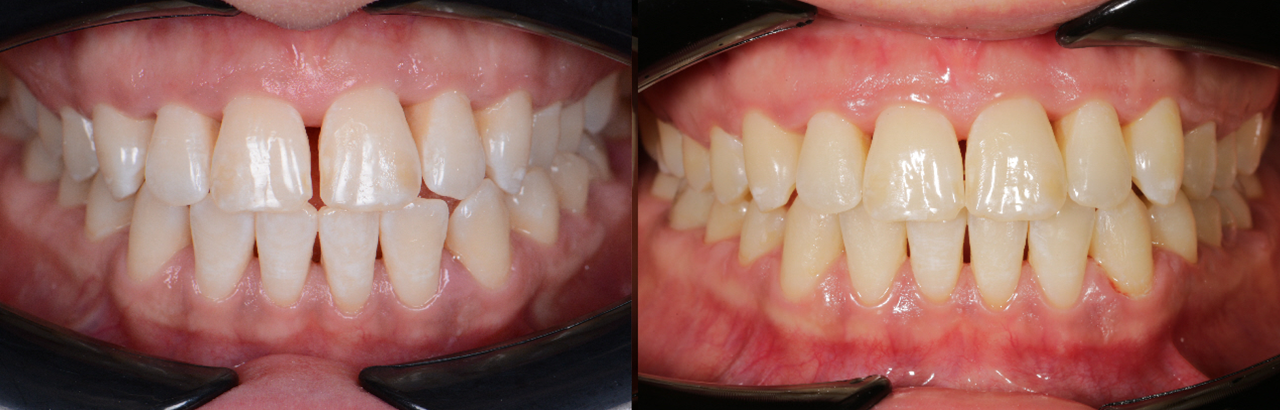 Zahnlücken Vorher