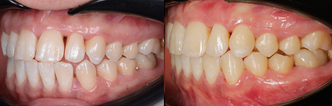 Zahnlücken Behandlung