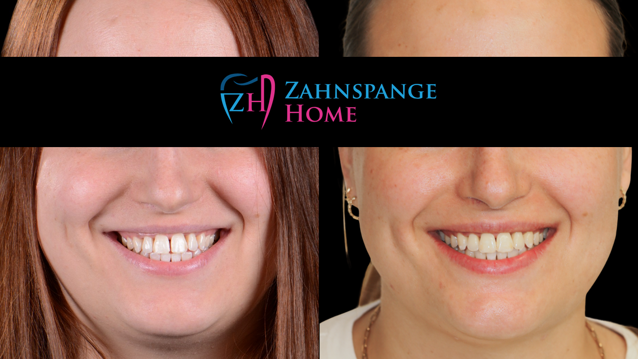 Zahnlücken Nachher