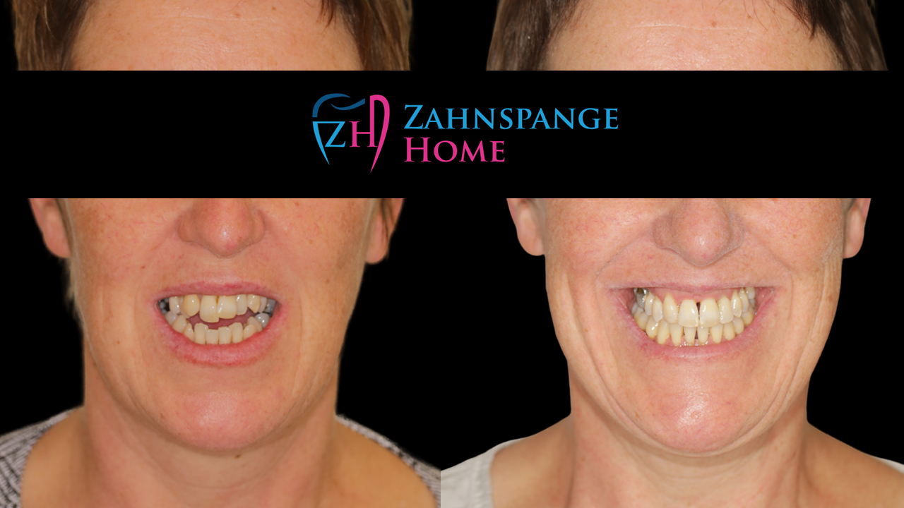 Offener Biss Nachher