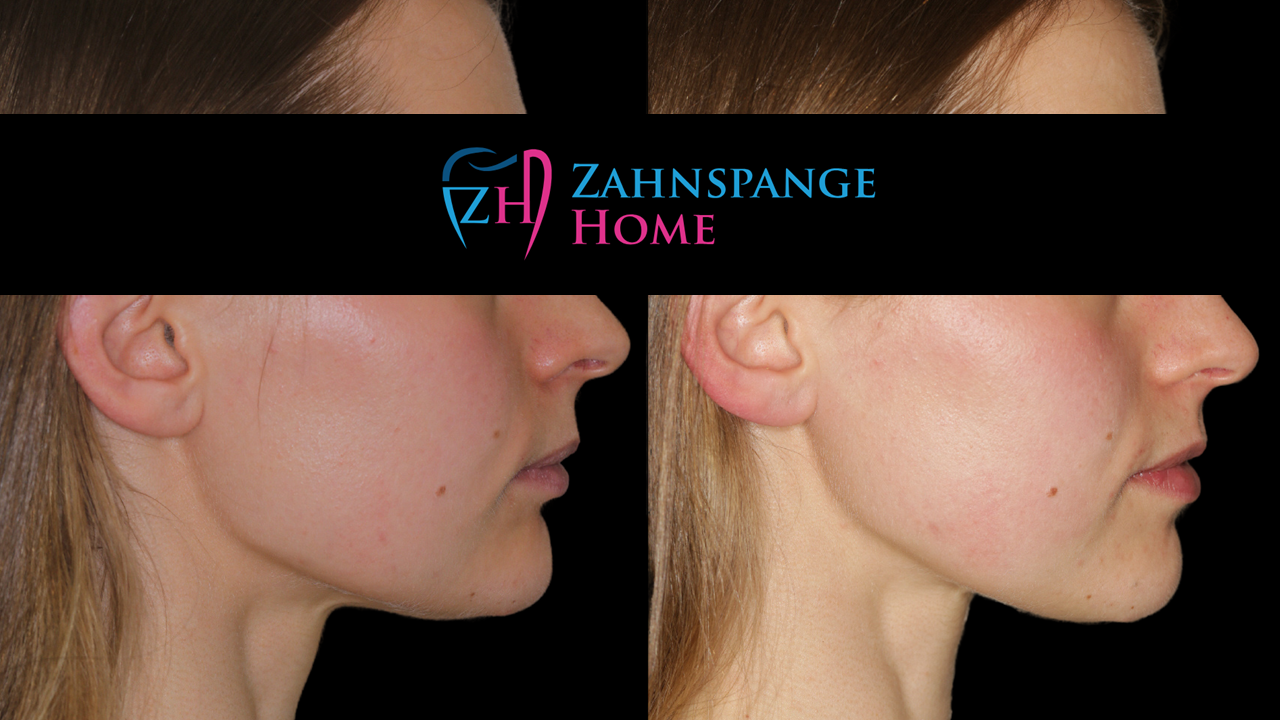 Überbiss Behandlung