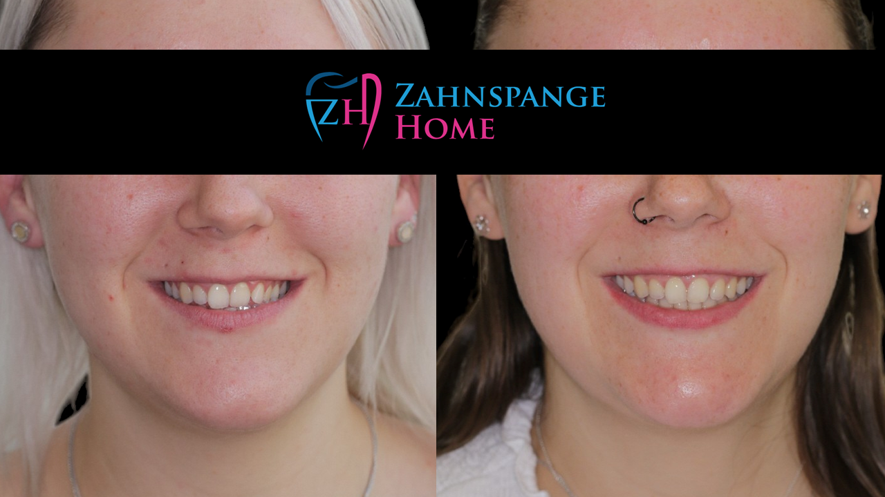 Posteriorer Kreuzbiss Vorher