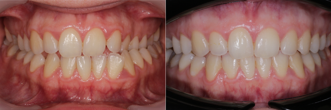 Posteriorer Kreuzbiss Behandlung