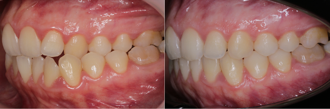 Posteriorer Kreuzbiss Nachher